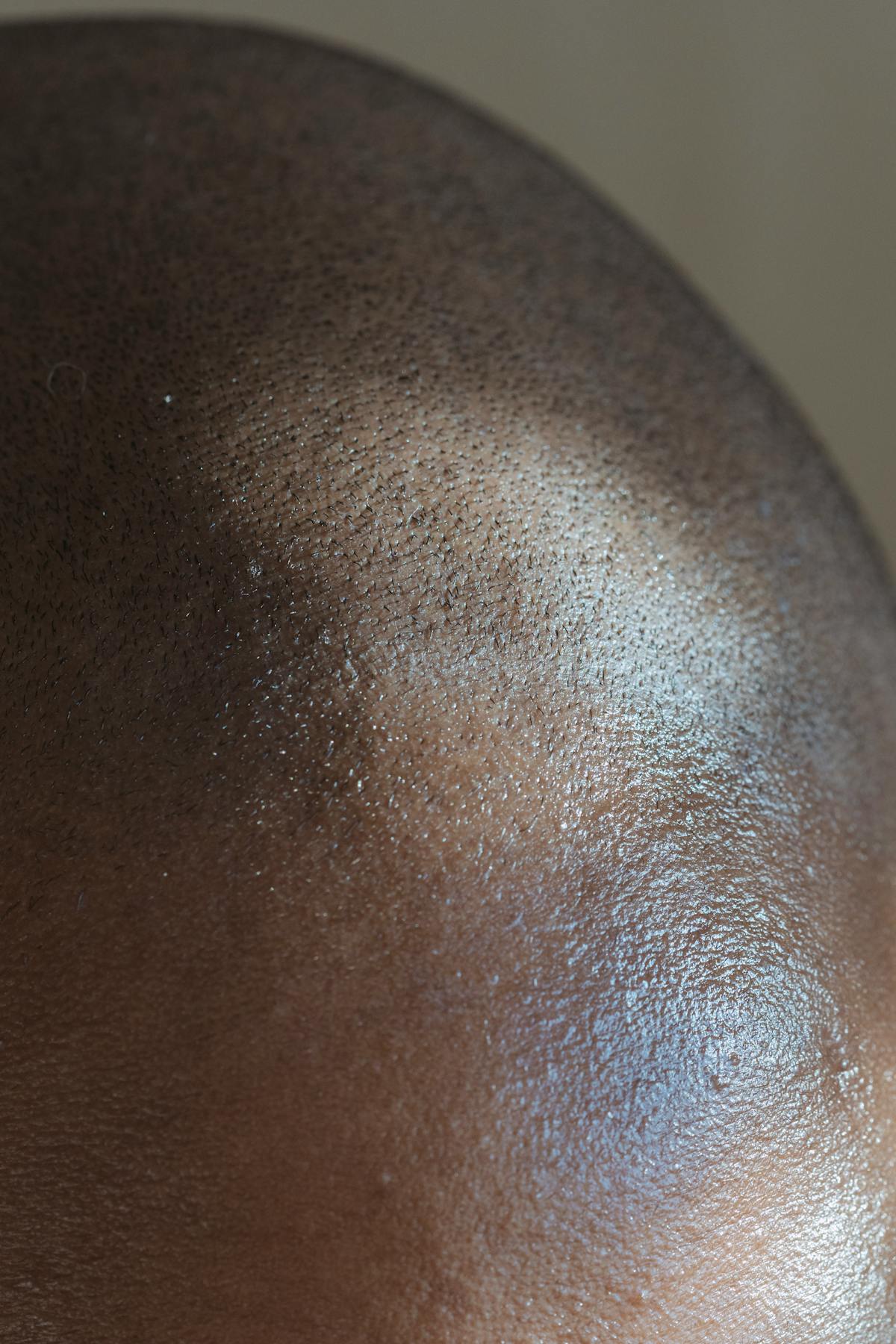 Hair loss before transplant
